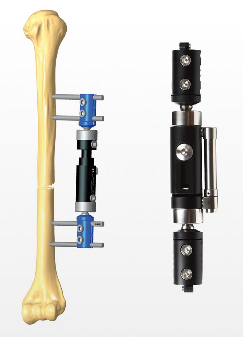 External Fixator