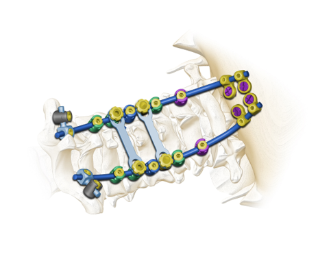 Spine System