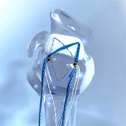 Adjustable Fixation Button
