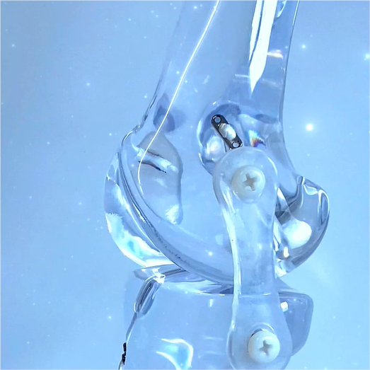 Adjustable Fixation Button